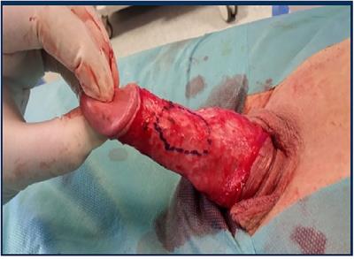 Global Perspective on the Management of Peyronie's Disease